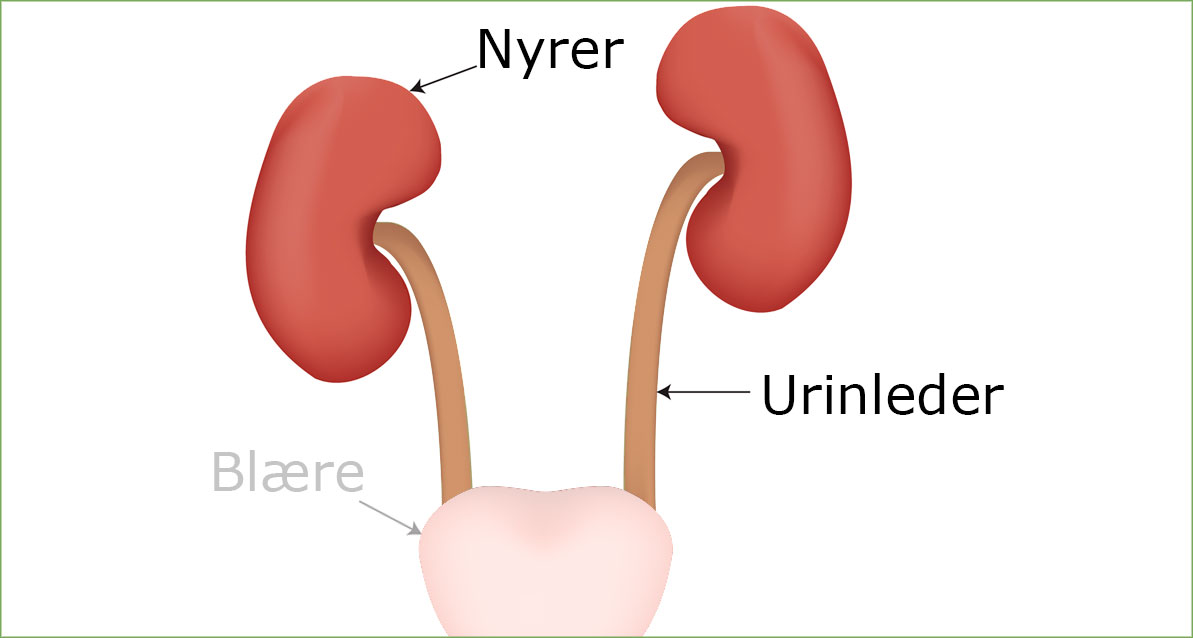 Urinveisinfeksjon i øvre urinveiene, nyrebekkenbetennelse, pyelonefritt